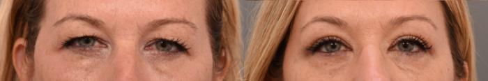 Eyelid Lift Case 1001596 Before & After Close Up | Serving Rochester, Syracuse & Buffalo, NY | Quatela Center for Plastic Surgery