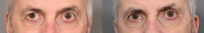 Eyelid Lift Case 1001598 Before & After Close Up | Serving Rochester, Syracuse & Buffalo, NY | Quatela Center for Plastic Surgery