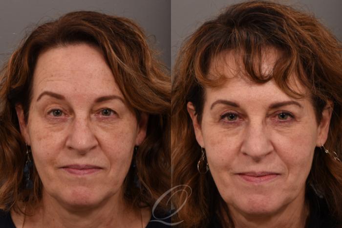 Eyelid Lift Case 1001599 Before & After Front | Serving Rochester, Syracuse & Buffalo, NY | Quatela Center for Plastic Surgery