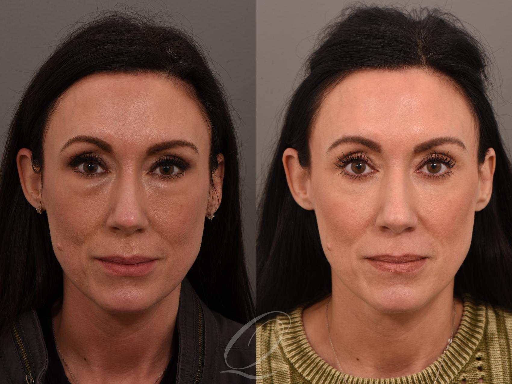 Eyelid Lift Case 1001639 Before & After Front | Serving Rochester, Syracuse & Buffalo, NY | Quatela Center for Plastic Surgery