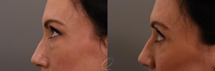 Eyelid Lift Case 1001639 Before & After Left Side | Serving Rochester, Syracuse & Buffalo, NY | Quatela Center for Plastic Surgery