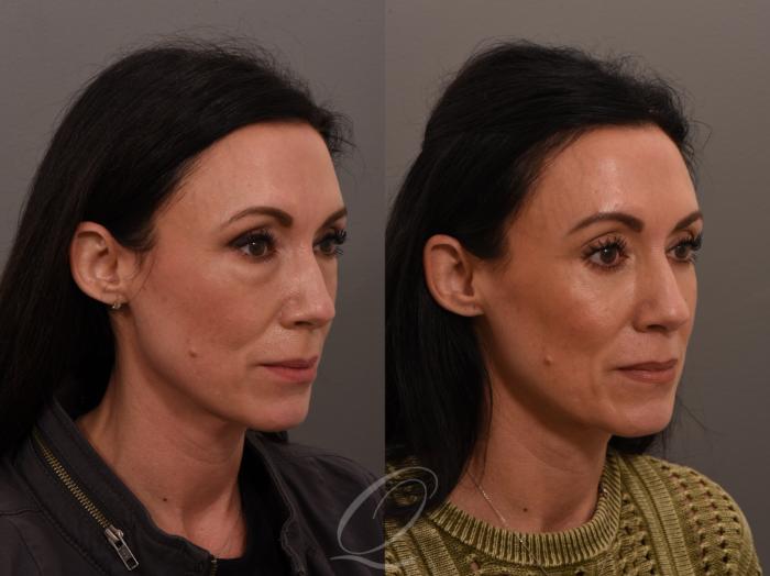 Eyelid Lift Case 1001639 Before & After Right Oblique | Serving Rochester, Syracuse & Buffalo, NY | Quatela Center for Plastic Surgery