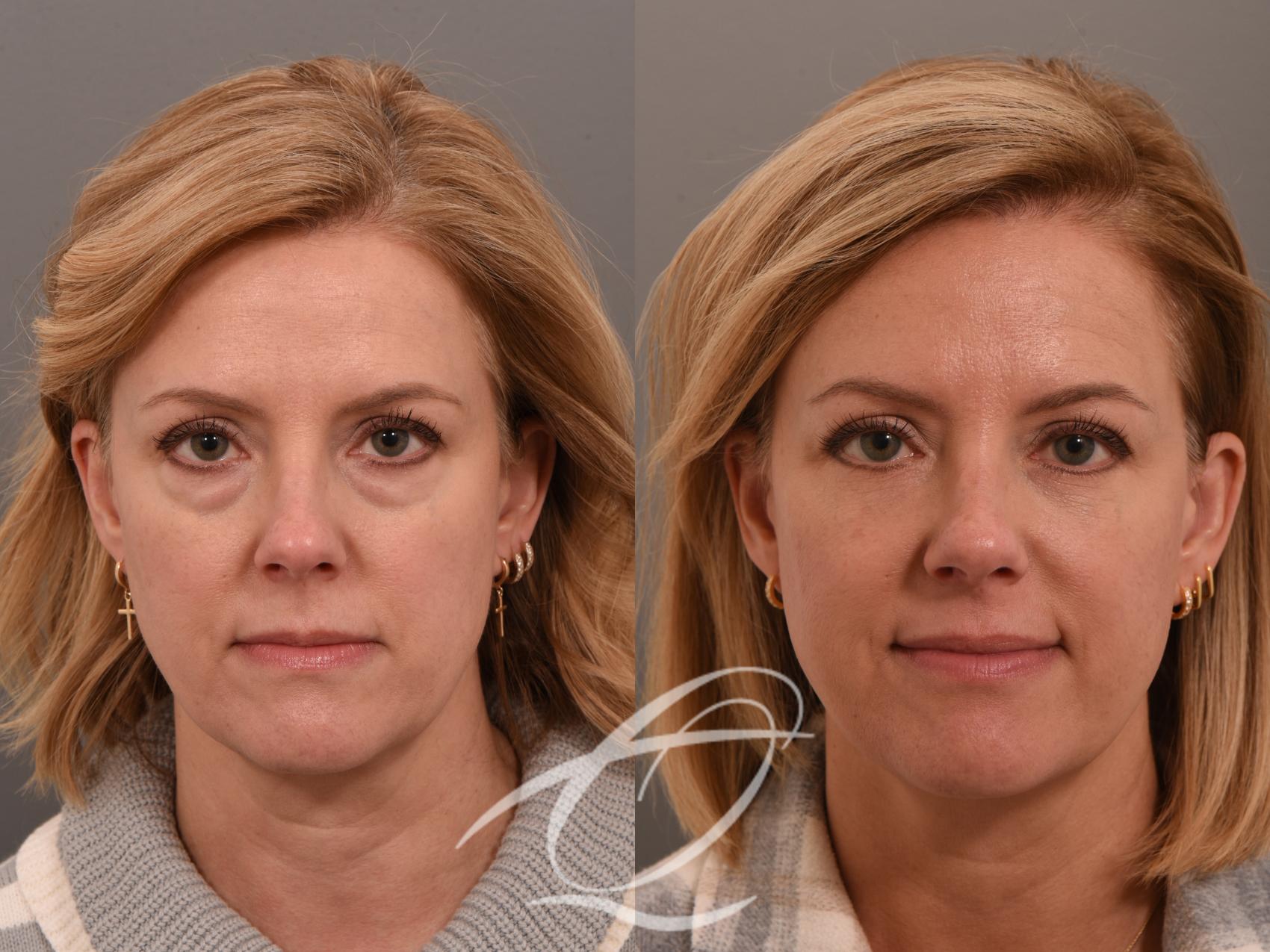 Eyelid Lift Lower Blepharoplasty The Permanent Solution For Under Eye