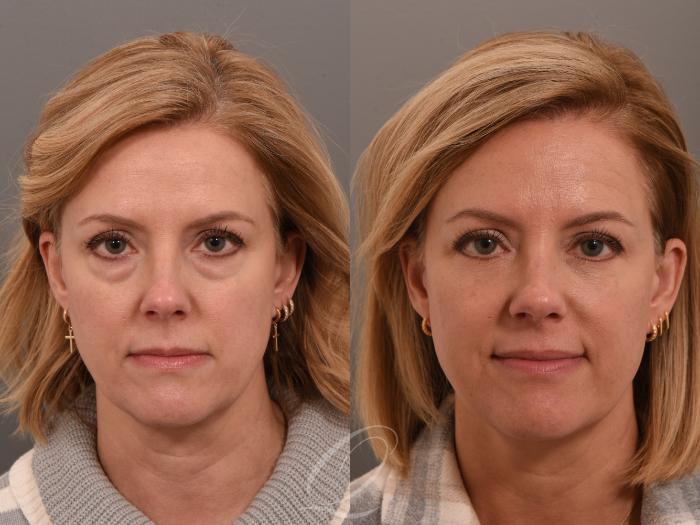 Eyelid Lift Case 1001641 Before & After Front | Serving Rochester, Syracuse & Buffalo, NY | Quatela Center for Plastic Surgery