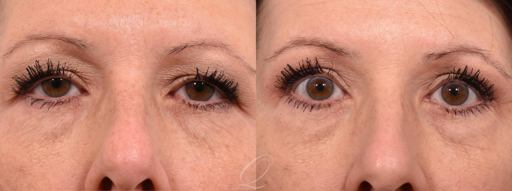 Eyelid Lift Case 1001736 Before & After Front | Serving Rochester, Syracuse & Buffalo, NY | Quatela Center for Plastic Surgery