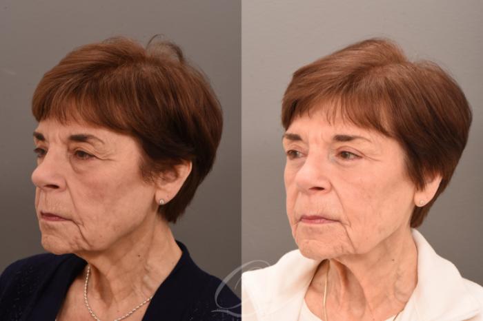 Eyelid Lift Case 1001757 Before & After Left Oblique | Serving Rochester, Syracuse & Buffalo, NY | Quatela Center for Plastic Surgery