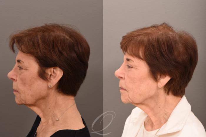 Eyelid Lift Case 1001757 Before & After Left Side | Serving Rochester, Syracuse & Buffalo, NY | Quatela Center for Plastic Surgery