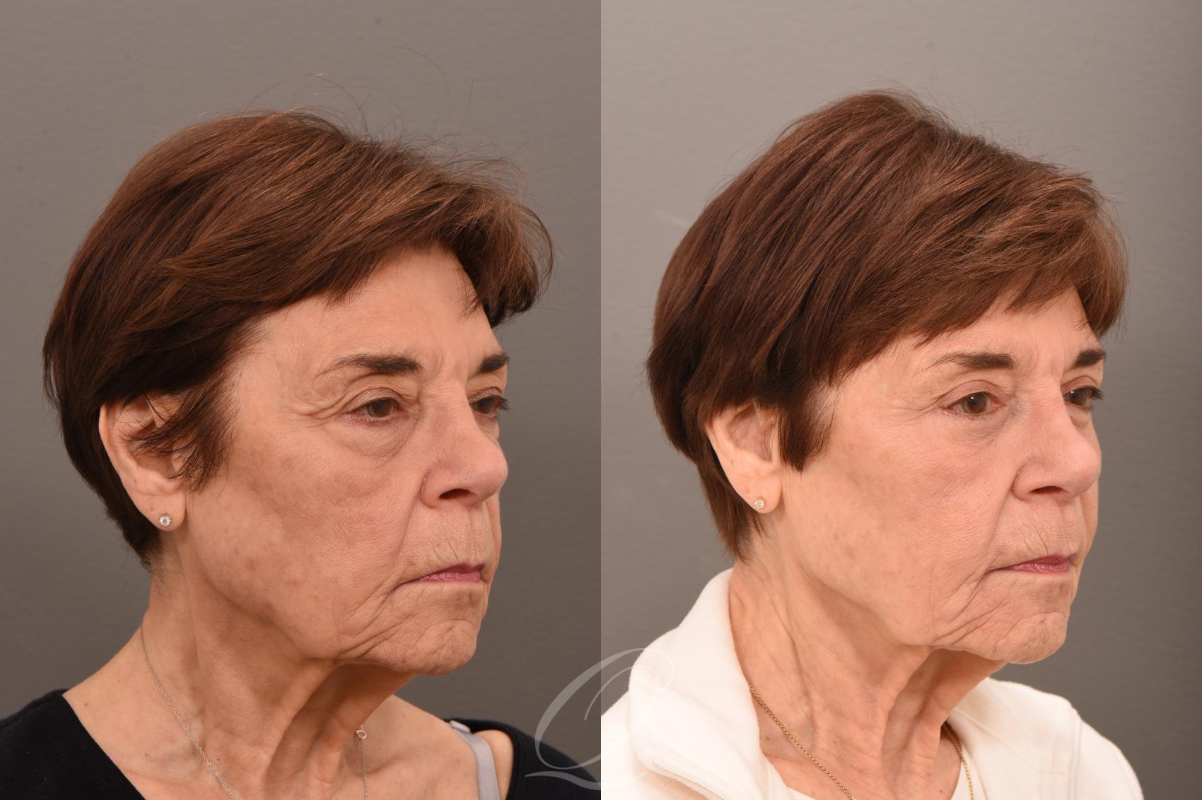 Eyelid Lift Case 1001757 Before & After Right Oblique | Serving Rochester, Syracuse & Buffalo, NY | Quatela Center for Plastic Surgery