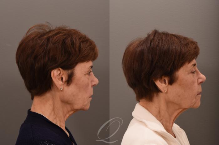 Eyelid Lift Case 1001757 Before & After Right Side | Serving Rochester, Syracuse & Buffalo, NY | Quatela Center for Plastic Surgery