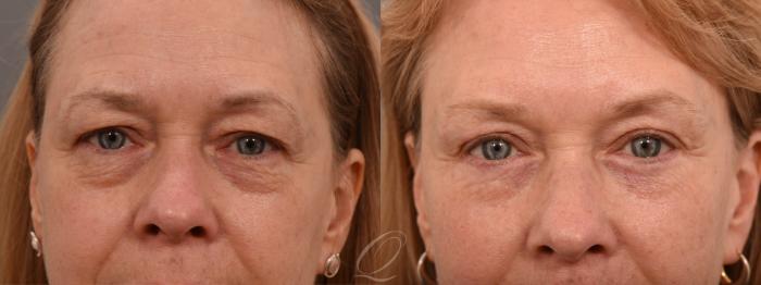 Eyelid Lift Case 1001789 Before & After Close Up | Serving Rochester, Syracuse & Buffalo, NY | Quatela Center for Plastic Surgery