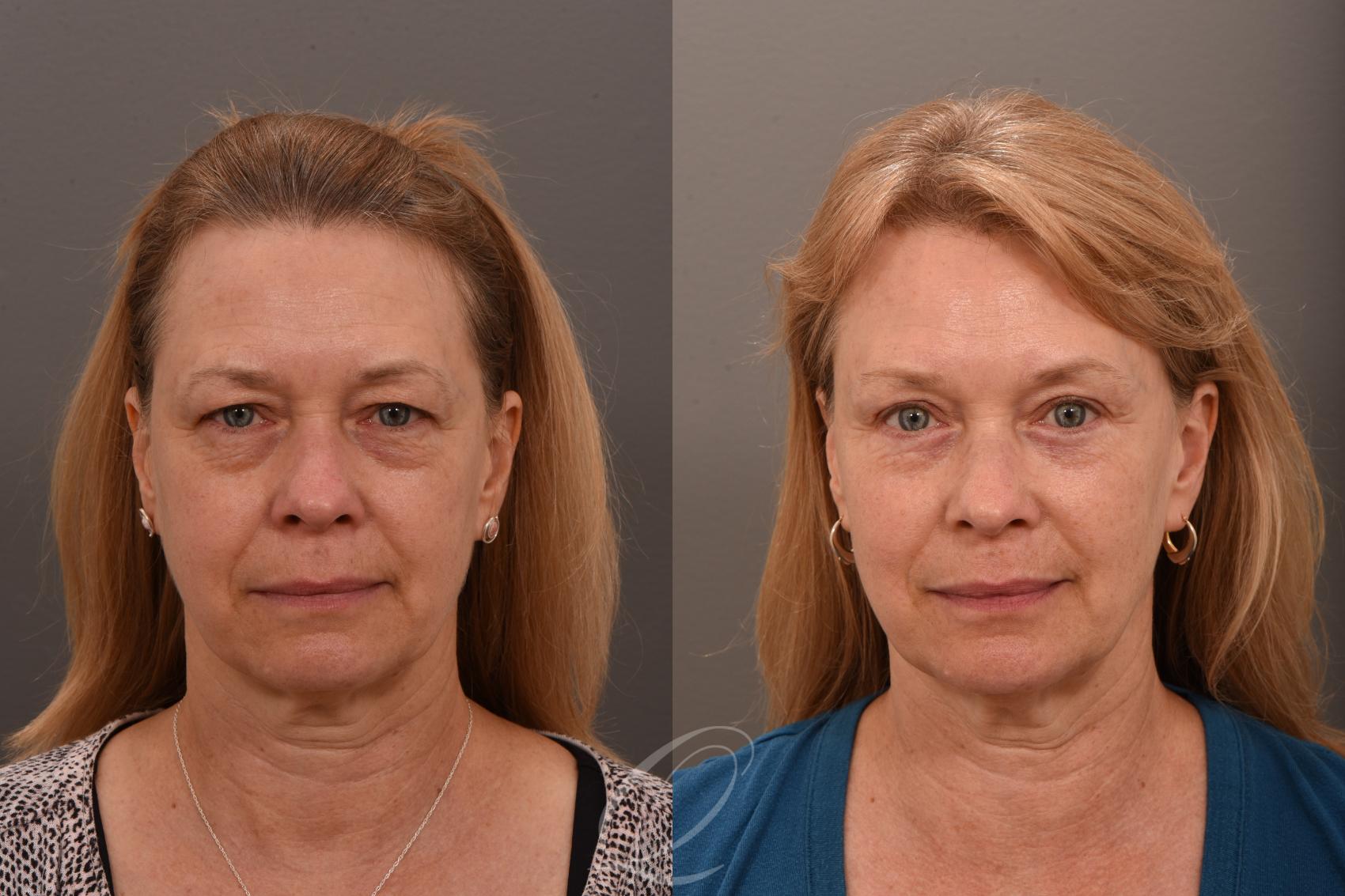 Eyelid Lift Case 1001789 Before & After Front | Serving Rochester, Syracuse & Buffalo, NY | Quatela Center for Plastic Surgery