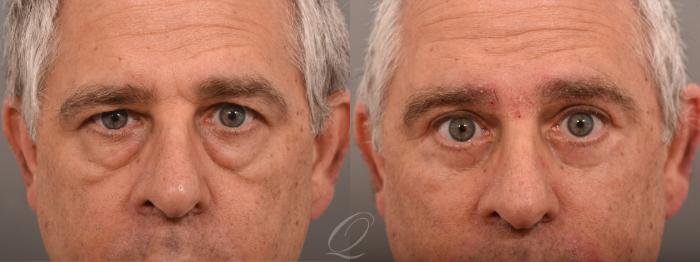 Eyelid Lift Case 1001790 Before & After Close Up | Serving Rochester, Syracuse & Buffalo, NY | Quatela Center for Plastic Surgery