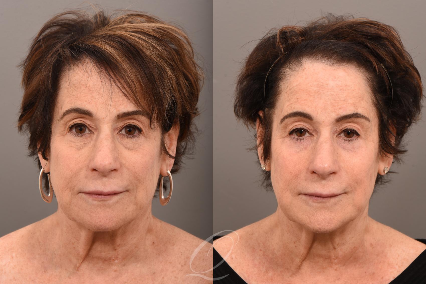 Eyelid Lift Case 1001791 Before & After Front | Serving Rochester, Syracuse & Buffalo, NY | Quatela Center for Plastic Surgery