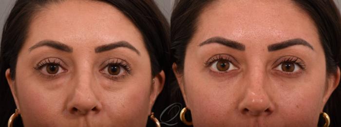 Eyelid Lift Case 1001792 Before & After Close Up | Serving Rochester, Syracuse & Buffalo, NY | Quatela Center for Plastic Surgery