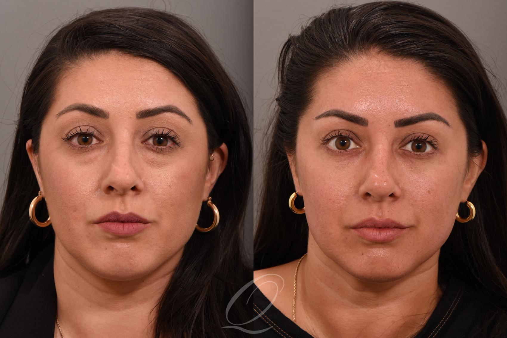 Eyelid Lift Case 1001792 Before & After Front | Serving Rochester, Syracuse & Buffalo, NY | Quatela Center for Plastic Surgery