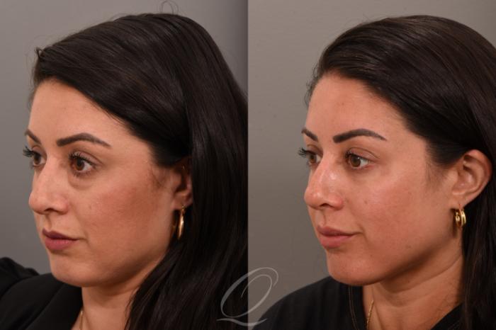 Eyelid Lift Case 1001792 Before & After Left Oblique | Serving Rochester, Syracuse & Buffalo, NY | Quatela Center for Plastic Surgery