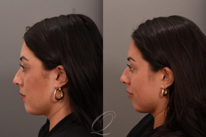 Eyelid Lift Case 1001792 Before & After Left Side | Serving Rochester, Syracuse & Buffalo, NY | Quatela Center for Plastic Surgery