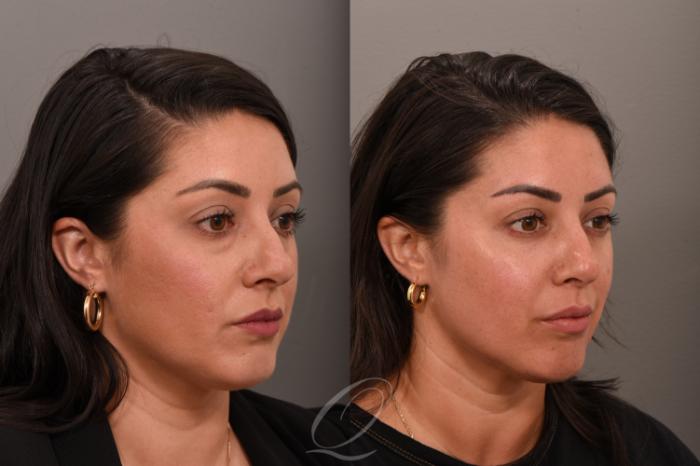 Eyelid Lift Case 1001792 Before & After Right Oblique | Serving Rochester, Syracuse & Buffalo, NY | Quatela Center for Plastic Surgery