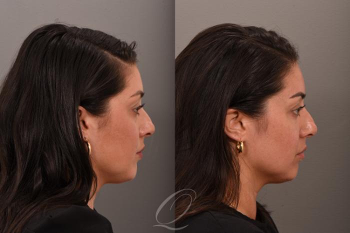 Eyelid Lift Case 1001792 Before & After Right Side | Serving Rochester, Syracuse & Buffalo, NY | Quatela Center for Plastic Surgery