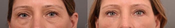 Eyelid Lift Case 1001793 Before & After Close Up | Serving Rochester, Syracuse & Buffalo, NY | Quatela Center for Plastic Surgery