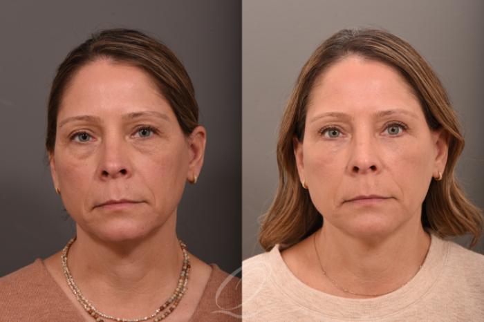 Eyelid Lift Case 1001793 Before & After Front | Serving Rochester, Syracuse & Buffalo, NY | Quatela Center for Plastic Surgery