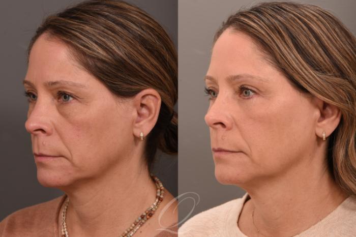 Eyelid Lift Case 1001793 Before & After Left Oblique | Serving Rochester, Syracuse & Buffalo, NY | Quatela Center for Plastic Surgery