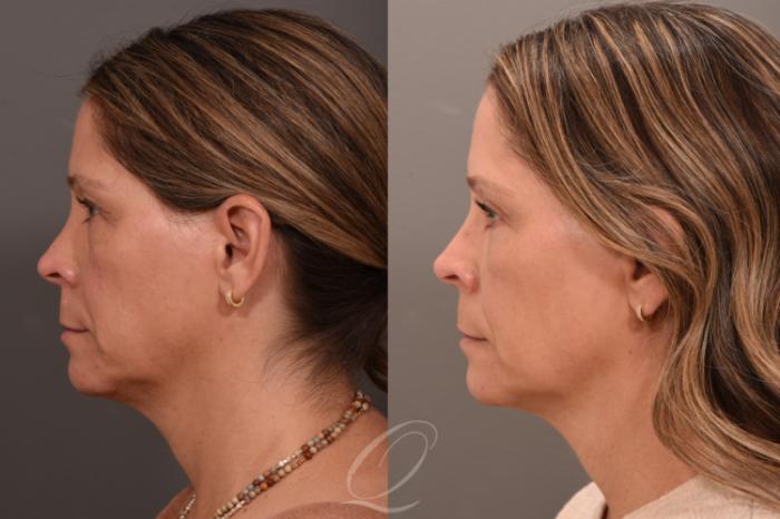 Eyelid Lift Case 1001793 Before & After Left Side | Serving Rochester, Syracuse & Buffalo, NY | Quatela Center for Plastic Surgery