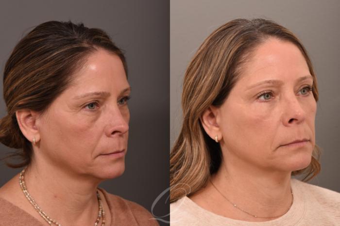 Eyelid Lift Case 1001793 Before & After Right Oblique | Serving Rochester, Syracuse & Buffalo, NY | Quatela Center for Plastic Surgery