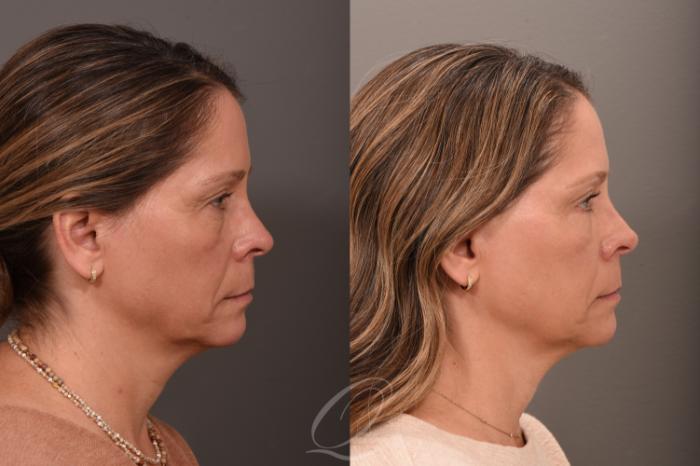 Eyelid Lift Case 1001793 Before & After Right Side | Serving Rochester, Syracuse & Buffalo, NY | Quatela Center for Plastic Surgery