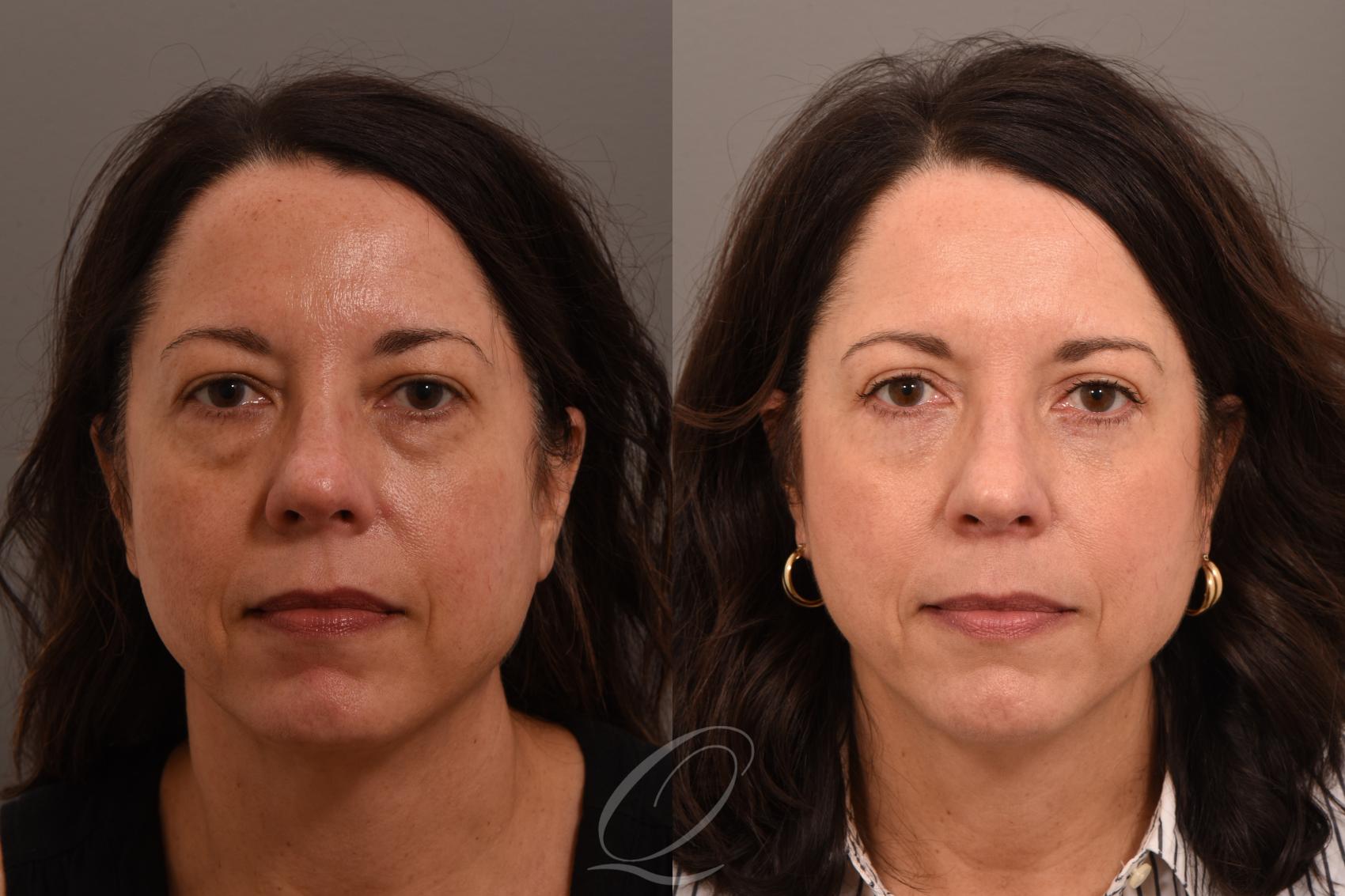 Eyelid Lift Case 1001861 Before & After Front | Serving Rochester, Syracuse & Buffalo, NY | Quatela Center for Plastic Surgery
