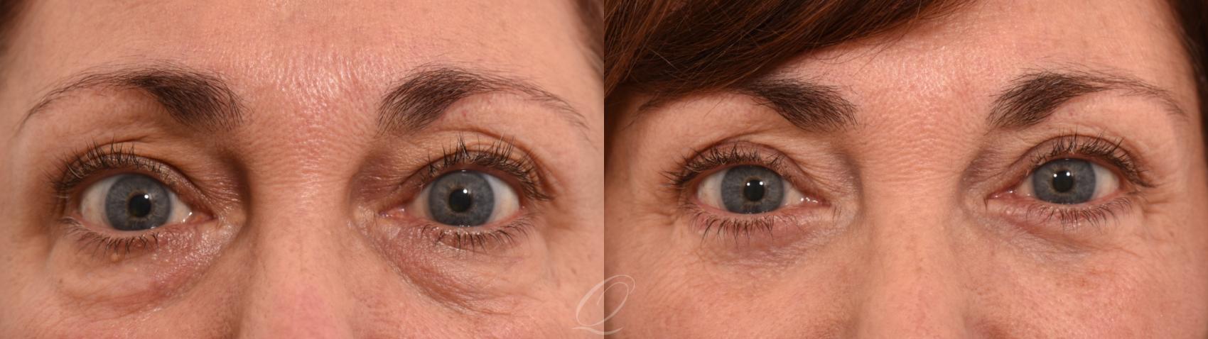 Eyelid Lift Case 1001961 Before & After Front | Serving Rochester, Syracuse & Buffalo, NY | Quatela Center for Plastic Surgery