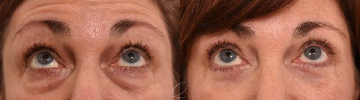 Eyelid Lift Case 1001961 Before & After Left Oblique | Serving Rochester, Syracuse & Buffalo, NY | Quatela Center for Plastic Surgery