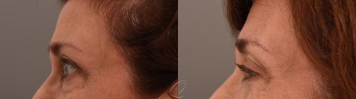 Eyelid Lift Case 1001961 Before & After Left Side | Serving Rochester, Syracuse & Buffalo, NY | Quatela Center for Plastic Surgery