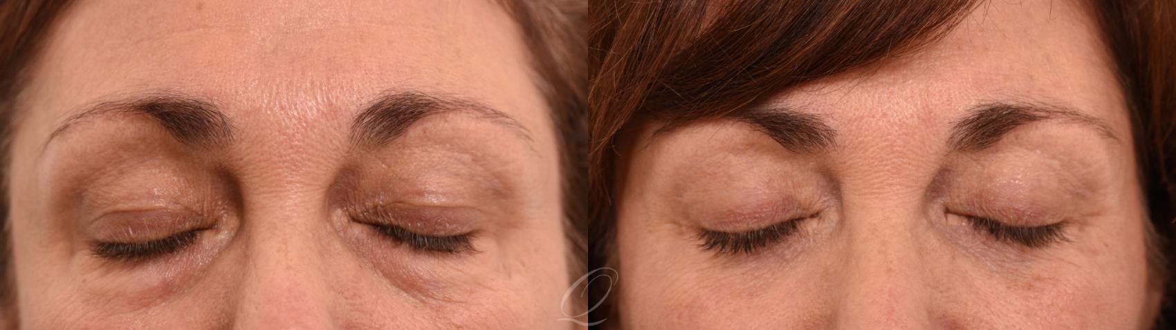 Eyelid Lift Case 1001961 Before & After Right Oblique | Serving Rochester, Syracuse & Buffalo, NY | Quatela Center for Plastic Surgery