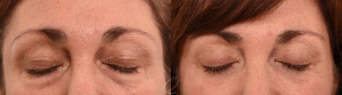 Eyelid Lift Case 1001961 Before & After Right Oblique | Serving Rochester, Syracuse & Buffalo, NY | Quatela Center for Plastic Surgery