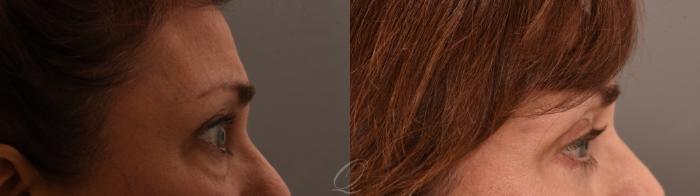 Eyelid Lift Case 1001961 Before & After Right Side | Serving Rochester, Syracuse & Buffalo, NY | Quatela Center for Plastic Surgery