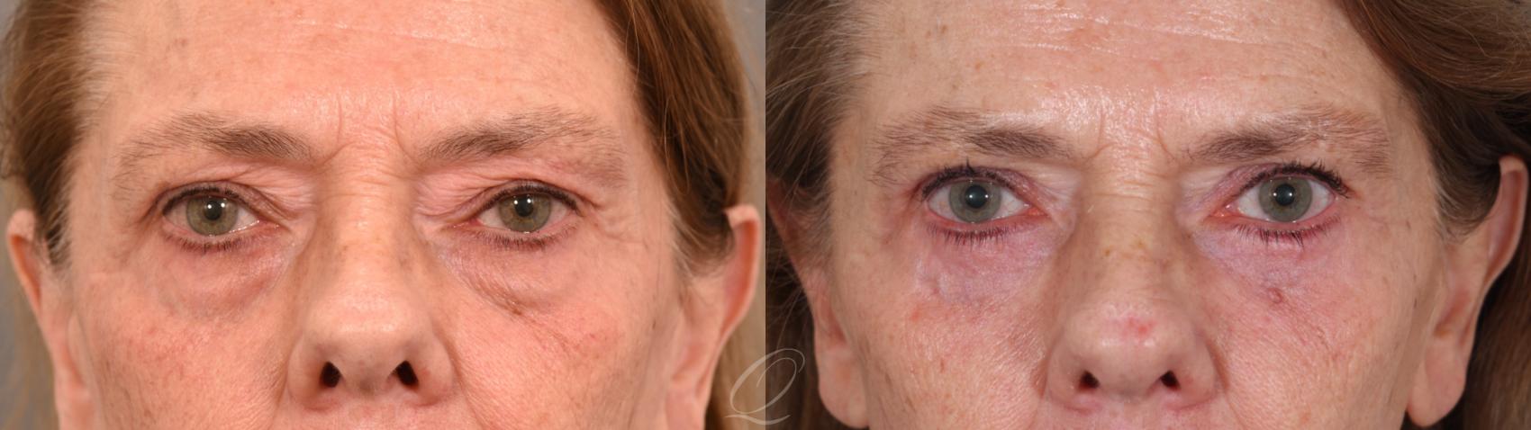 Eyelid Lift Case 1002001 Before & After Back | Serving Rochester, Syracuse & Buffalo, NY | Quatela Center for Plastic Surgery