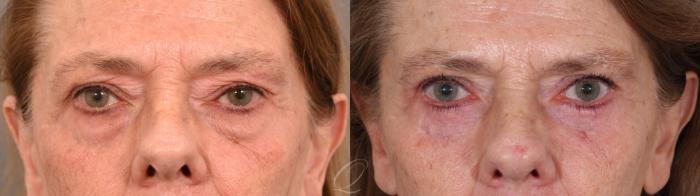 Eyelid Lift Case 1002001 Before & After Back | Serving Rochester, Syracuse & Buffalo, NY | Quatela Center for Plastic Surgery