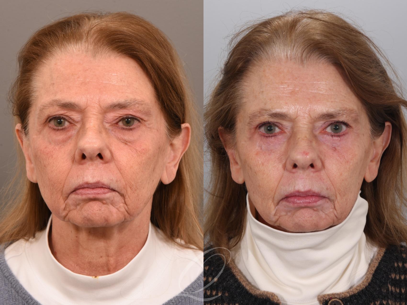 Eyelid Lift Case 1002001 Before & After Front | Serving Rochester, Syracuse & Buffalo, NY | Quatela Center for Plastic Surgery