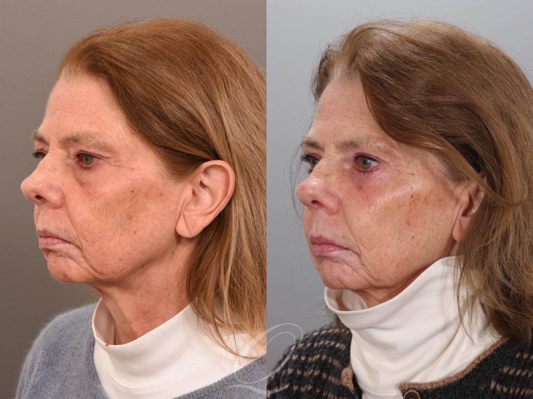 Eyelid Lift Case 1002001 Before & After Left Oblique | Serving Rochester, Syracuse & Buffalo, NY | Quatela Center for Plastic Surgery