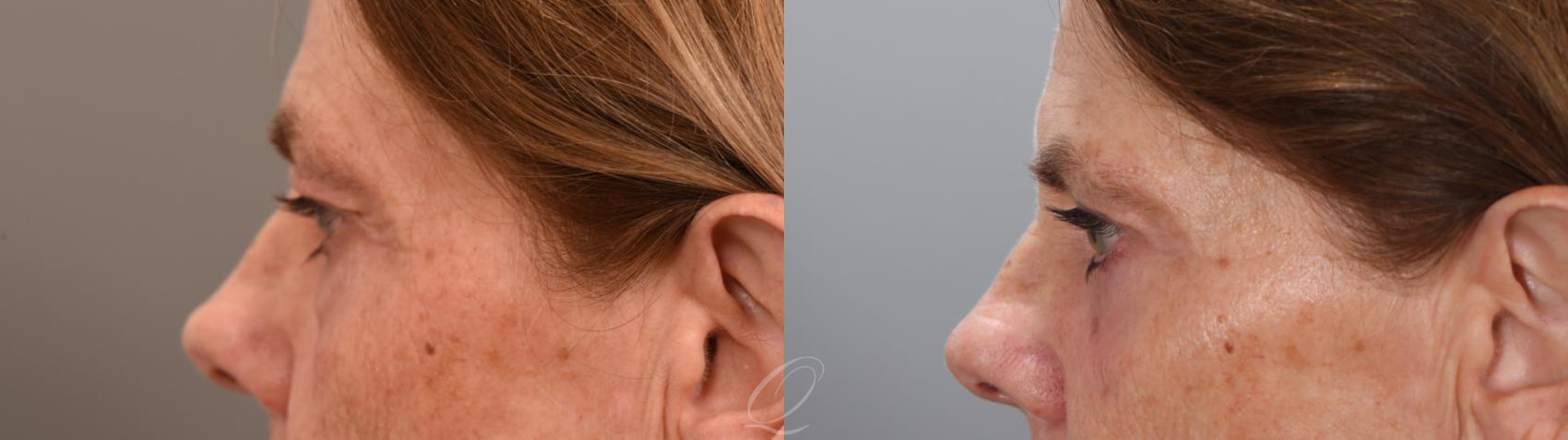Eyelid Lift Case 1002001 Before & After Left Side | Serving Rochester, Syracuse & Buffalo, NY | Quatela Center for Plastic Surgery