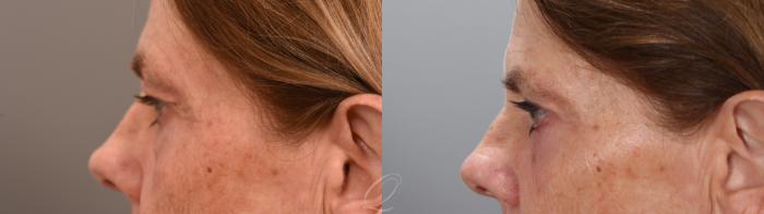 Eyelid Lift Case 1002001 Before & After Left Side | Serving Rochester, Syracuse & Buffalo, NY | Quatela Center for Plastic Surgery
