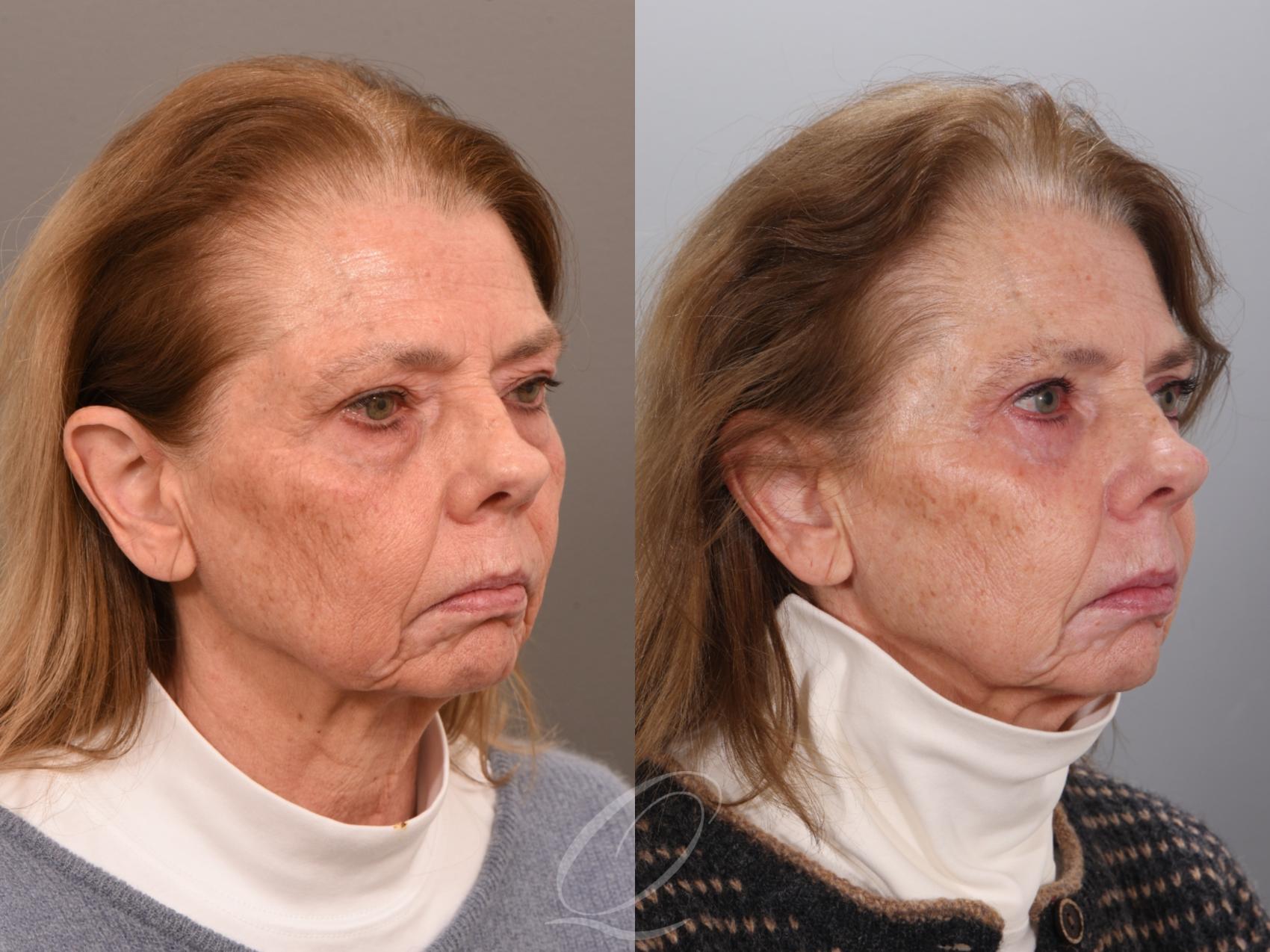 Eyelid Lift Case 1002001 Before & After Right Oblique | Serving Rochester, Syracuse & Buffalo, NY | Quatela Center for Plastic Surgery