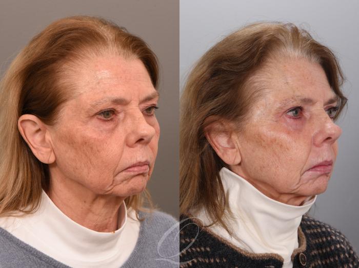 Eyelid Lift Case 1002001 Before & After Right Oblique | Serving Rochester, Syracuse & Buffalo, NY | Quatela Center for Plastic Surgery