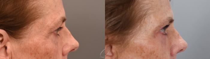 Eyelid Lift Case 1002001 Before & After Right Side | Serving Rochester, Syracuse & Buffalo, NY | Quatela Center for Plastic Surgery