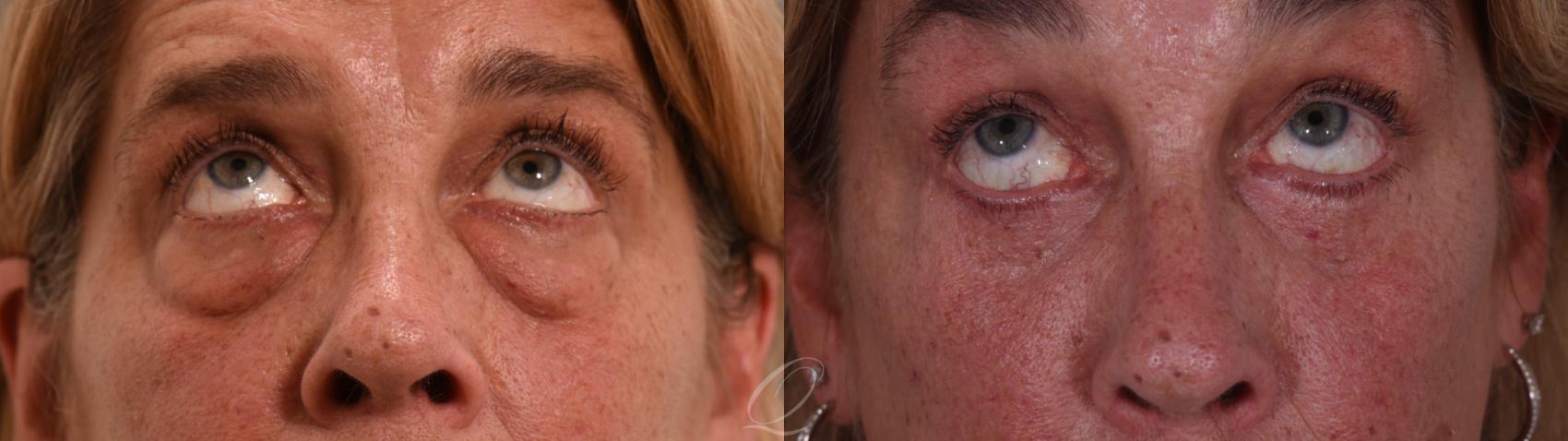 Eyelid Lift Case 1002002 Before & After Back | Serving Rochester, Syracuse & Buffalo, NY | Quatela Center for Plastic Surgery
