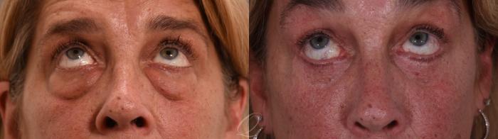 Eyelid Lift Case 1002002 Before & After Back | Serving Rochester, Syracuse & Buffalo, NY | Quatela Center for Plastic Surgery