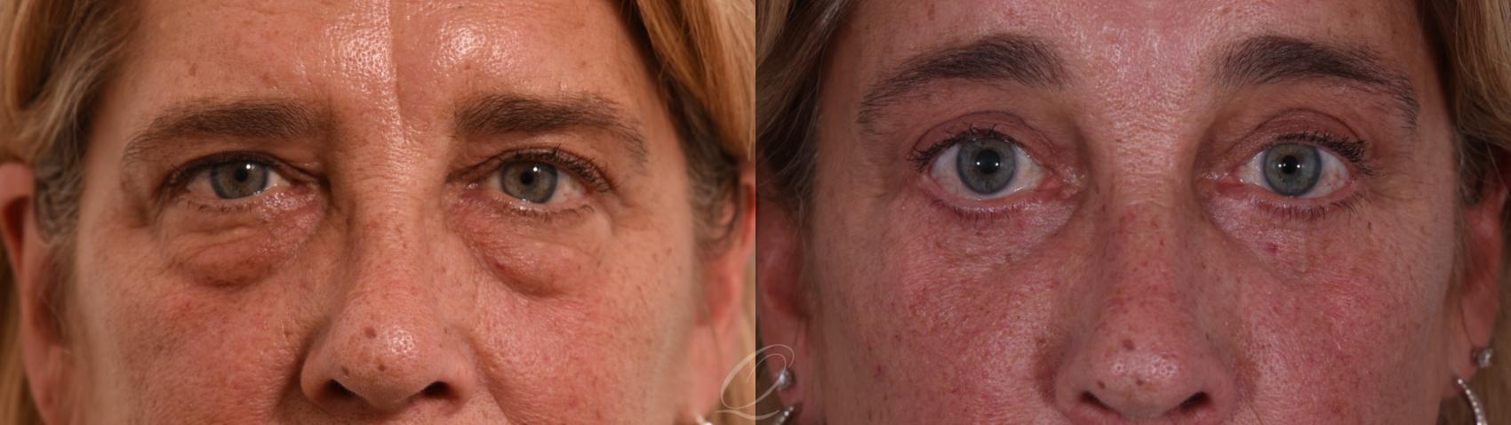 Eyelid Lift Case 1002002 Before & After Front | Serving Rochester, Syracuse & Buffalo, NY | Quatela Center for Plastic Surgery