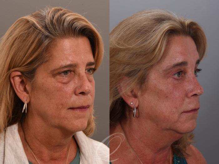 Eyelid Lift Case 1002002 Before & After Left Oblique | Serving Rochester, Syracuse & Buffalo, NY | Quatela Center for Plastic Surgery