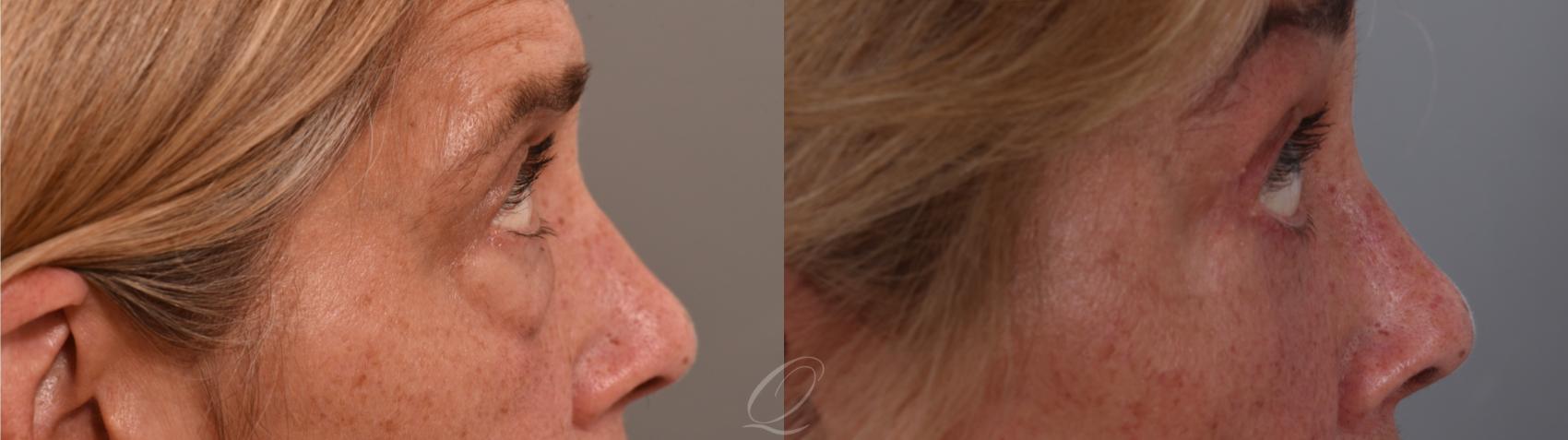 Eyelid Lift Case 1002002 Before & After Left Side | Serving Rochester, Syracuse & Buffalo, NY | Quatela Center for Plastic Surgery
